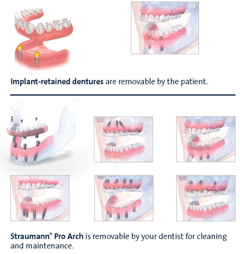 illustration of a dental implant