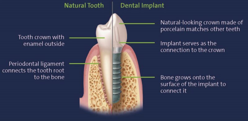 illustration of a dental implant