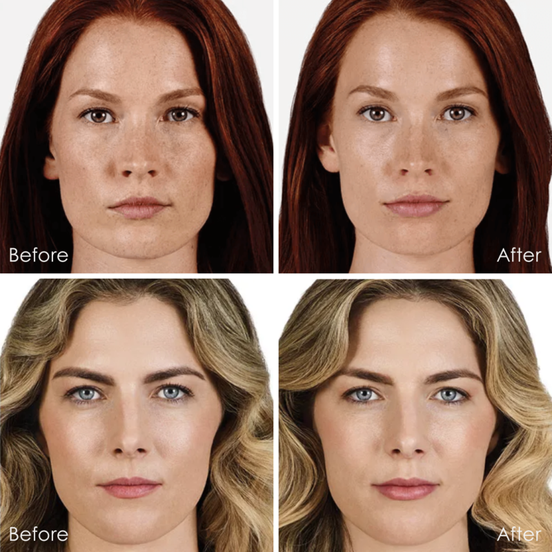 juvaderm ultraxc before and after