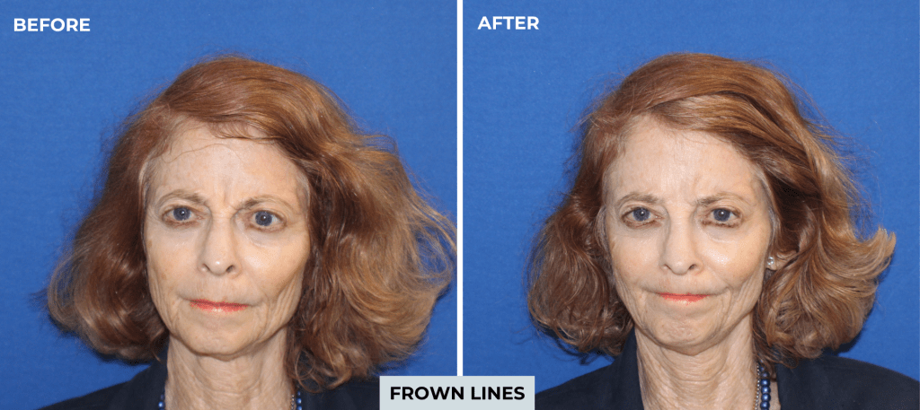 Botox before and after photo