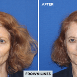 Botox before and after photo