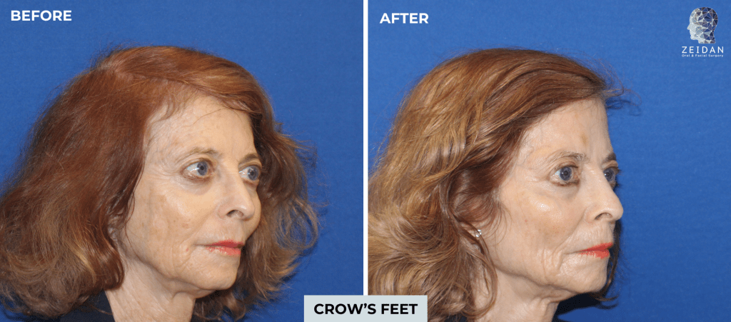Botox before and after photo