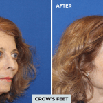 Botox before and after photo