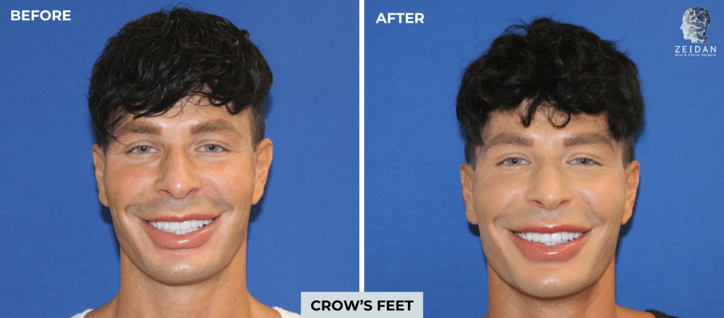 Botox before and after photo