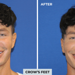 Botox before and after photo