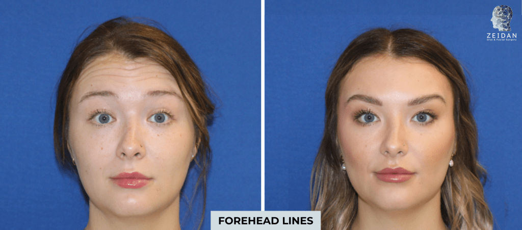 Botox before and after photo