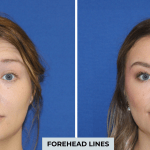 Botox before and after photo