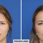 Botox before and after photo