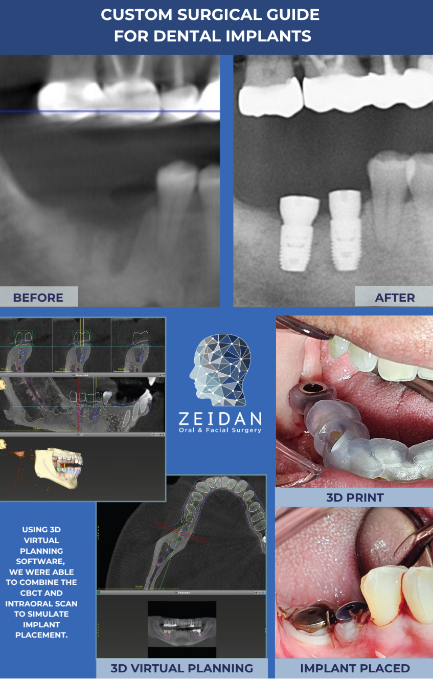 Custom Surgical Guide Dental Implant Technology process